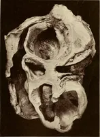 An illustration from A practical treatise on genito-urinary and venereal diseases and syphilis / By Robert W. Taylor. (1904)