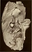 Picture 49 of 58 from A practical treatise on genito-urinary and venereal diseases and syphilis / By Robert W. Taylor. (1904), leaf 467