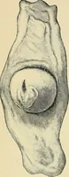An illustration from A practical treatise on genito-urinary and venereal diseases and syphilis / By Robert W. Taylor. (1904)