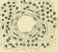 An illustration from A practical treatise on genito-urinary and venereal diseases and syphilis / By Robert W. Taylor. (1904)