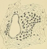 An illustration from A practical treatise on genito-urinary and venereal diseases and syphilis / By Robert W. Taylor. (1904)