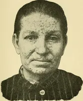 An illustration from A practical treatise on genito-urinary and venereal diseases and syphilis / By Robert W. Taylor. (1904)