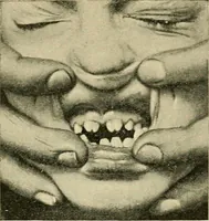 Picture 58 of 58 from A practical treatise on genito-urinary and venereal diseases and syphilis / By Robert W. Taylor. (1904), leaf 805