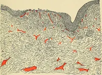 Picture 16 of 58 from A practical treatise on genito-urinary and venereal diseases and syphilis / By Robert W. Taylor. (1904), leaf 83