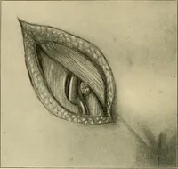 An illustration from The principles and practice of modern surgery / by Roswell Park ... with 722 engravings and 60 full-page plates in colors and monochrome. (1907)