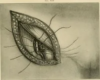 Picture 181 of 224 from The principles and practice of modern surgery / by Roswell Park ... with 722 engravings and 60 full-page plates in colors and monochrome. (1907), leaf 1017