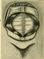 An illustration from The principles and practice of modern surgery / by Roswell Park ... with 722 engravings and 60 full-page plates in colors and monochrome. (1907)