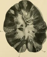 Picture 184 of 224 from The principles and practice of modern surgery / by Roswell Park ... with 722 engravings and 60 full-page plates in colors and monochrome. (1907), leaf 1077