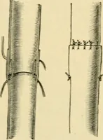 Picture 185 of 224 from The principles and practice of modern surgery / by Roswell Park ... with 722 engravings and 60 full-page plates in colors and monochrome. (1907), leaf 1090