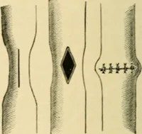 An illustration from The principles and practice of modern surgery / by Roswell Park ... with 722 engravings and 60 full-page plates in colors and monochrome. (1907)
