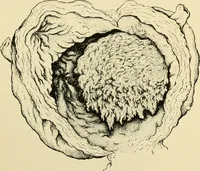 Picture 189 of 224 from The principles and practice of modern surgery / by Roswell Park ... with 722 engravings and 60 full-page plates in colors and monochrome. (1907), leaf 1106
