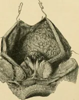Picture 190 of 224 from The principles and practice of modern surgery / by Roswell Park ... with 722 engravings and 60 full-page plates in colors and monochrome. (1907), leaf 1111