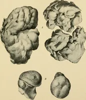 An illustration from The principles and practice of modern surgery / by Roswell Park ... with 722 engravings and 60 full-page plates in colors and monochrome. (1907)