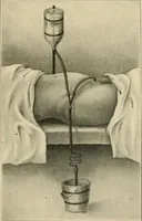 An illustration from The principles and practice of modern surgery / by Roswell Park ... with 722 engravings and 60 full-page plates in colors and monochrome. (1907)