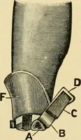 Picture 196 of 224 from The principles and practice of modern surgery / by Roswell Park ... with 722 engravings and 60 full-page plates in colors and monochrome. (1907), leaf 1142
