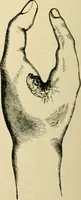 An illustration from The principles and practice of modern surgery / by Roswell Park ... with 722 engravings and 60 full-page plates in colors and monochrome. (1907)