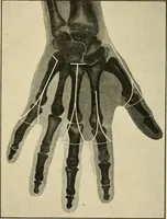 An illustration from The principles and practice of modern surgery / by Roswell Park ... with 722 engravings and 60 full-page plates in colors and monochrome. (1907)