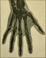 An illustration from The principles and practice of modern surgery / by Roswell Park ... with 722 engravings and 60 full-page plates in colors and monochrome. (1907)
