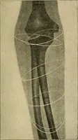 An illustration from The principles and practice of modern surgery / by Roswell Park ... with 722 engravings and 60 full-page plates in colors and monochrome. (1907)