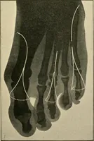 An illustration from The principles and practice of modern surgery / by Roswell Park ... with 722 engravings and 60 full-page plates in colors and monochrome. (1907)