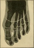 Picture 207 of 224 from The principles and practice of modern surgery / by Roswell Park ... with 722 engravings and 60 full-page plates in colors and monochrome. (1907), leaf 1155
