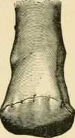 An illustration from The principles and practice of modern surgery / by Roswell Park ... with 722 engravings and 60 full-page plates in colors and monochrome. (1907)