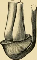 Picture 211 of 224 from The principles and practice of modern surgery / by Roswell Park ... with 722 engravings and 60 full-page plates in colors and monochrome. (1907), leaf 1158