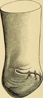 An illustration from The principles and practice of modern surgery / by Roswell Park ... with 722 engravings and 60 full-page plates in colors and monochrome. (1907)