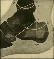 An illustration from The principles and practice of modern surgery / by Roswell Park ... with 722 engravings and 60 full-page plates in colors and monochrome. (1907)