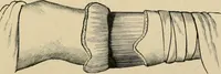 An illustration from The principles and practice of modern surgery / by Roswell Park ... with 722 engravings and 60 full-page plates in colors and monochrome. (1907)