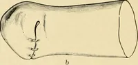An illustration from The principles and practice of modern surgery / by Roswell Park ... with 722 engravings and 60 full-page plates in colors and monochrome. (1907)
