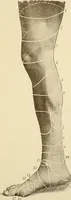An illustration from The principles and practice of modern surgery / by Roswell Park ... with 722 engravings and 60 full-page plates in colors and monochrome. (1907)