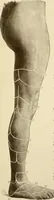 An illustration from The principles and practice of modern surgery / by Roswell Park ... with 722 engravings and 60 full-page plates in colors and monochrome. (1907)