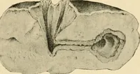 Picture 14 of 224 from The principles and practice of modern surgery / by Roswell Park ... with 722 engravings and 60 full-page plates in colors and monochrome. (1907), leaf 135
