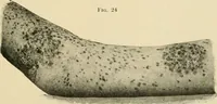 Picture 15 of 224 from The principles and practice of modern surgery / by Roswell Park ... with 722 engravings and 60 full-page plates in colors and monochrome. (1907), leaf 155