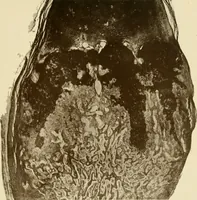 An illustration from The principles and practice of modern surgery / by Roswell Park ... with 722 engravings and 60 full-page plates in colors and monochrome. (1907)