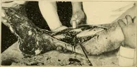 Picture 23 of 224 from The principles and practice of modern surgery / by Roswell Park ... with 722 engravings and 60 full-page plates in colors and monochrome. (1907), leaf 258