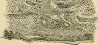 An illustration from The principles and practice of modern surgery / by Roswell Park ... with 722 engravings and 60 full-page plates in colors and monochrome. (1907)