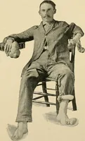 Picture 32 of 224 from The principles and practice of modern surgery / by Roswell Park ... with 722 engravings and 60 full-page plates in colors and monochrome. (1907), leaf 305