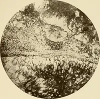 An illustration from The principles and practice of modern surgery / by Roswell Park ... with 722 engravings and 60 full-page plates in colors and monochrome. (1907)