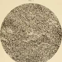 Picture 37 of 224 from The principles and practice of modern surgery / by Roswell Park ... with 722 engravings and 60 full-page plates in colors and monochrome. (1907), leaf 329