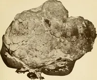 Picture 38 of 224 from The principles and practice of modern surgery / by Roswell Park ... with 722 engravings and 60 full-page plates in colors and monochrome. (1907), leaf 335