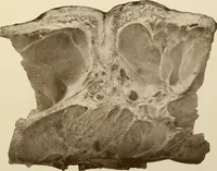 Picture 39 of 224 from The principles and practice of modern surgery / by Roswell Park ... with 722 engravings and 60 full-page plates in colors and monochrome. (1907), leaf 339