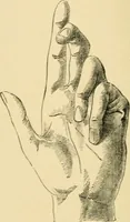 An illustration from The principles and practice of modern surgery / by Roswell Park ... with 722 engravings and 60 full-page plates in colors and monochrome. (1907)