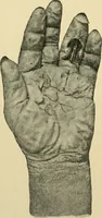 An illustration from The principles and practice of modern surgery / by Roswell Park ... with 722 engravings and 60 full-page plates in colors and monochrome. (1907)