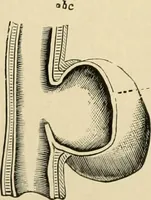 An illustration from The principles and practice of modern surgery / by Roswell Park ... with 722 engravings and 60 full-page plates in colors and monochrome. (1907)