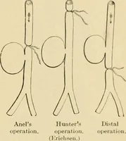 Picture 55 of 224 from The principles and practice of modern surgery / by Roswell Park ... with 722 engravings and 60 full-page plates in colors and monochrome. (1907), leaf 409