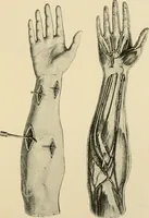 An illustration from The principles and practice of modern surgery / by Roswell Park ... with 722 engravings and 60 full-page plates in colors and monochrome. (1907)