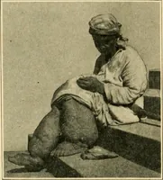 Picture 63 of 224 from The principles and practice of modern surgery / by Roswell Park ... with 722 engravings and 60 full-page plates in colors and monochrome. (1907), leaf 440