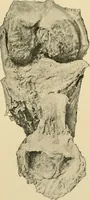 Picture 69 of 224 from The principles and practice of modern surgery / by Roswell Park ... with 722 engravings and 60 full-page plates in colors and monochrome. (1907), leaf 463